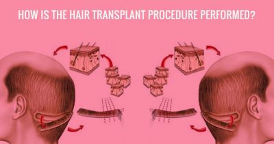 What are the pros and cons of the FUE Hair Transplant