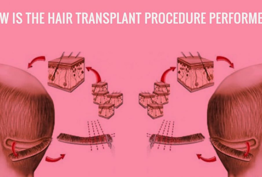 What are the pros and cons of the FUE Hair Transplant